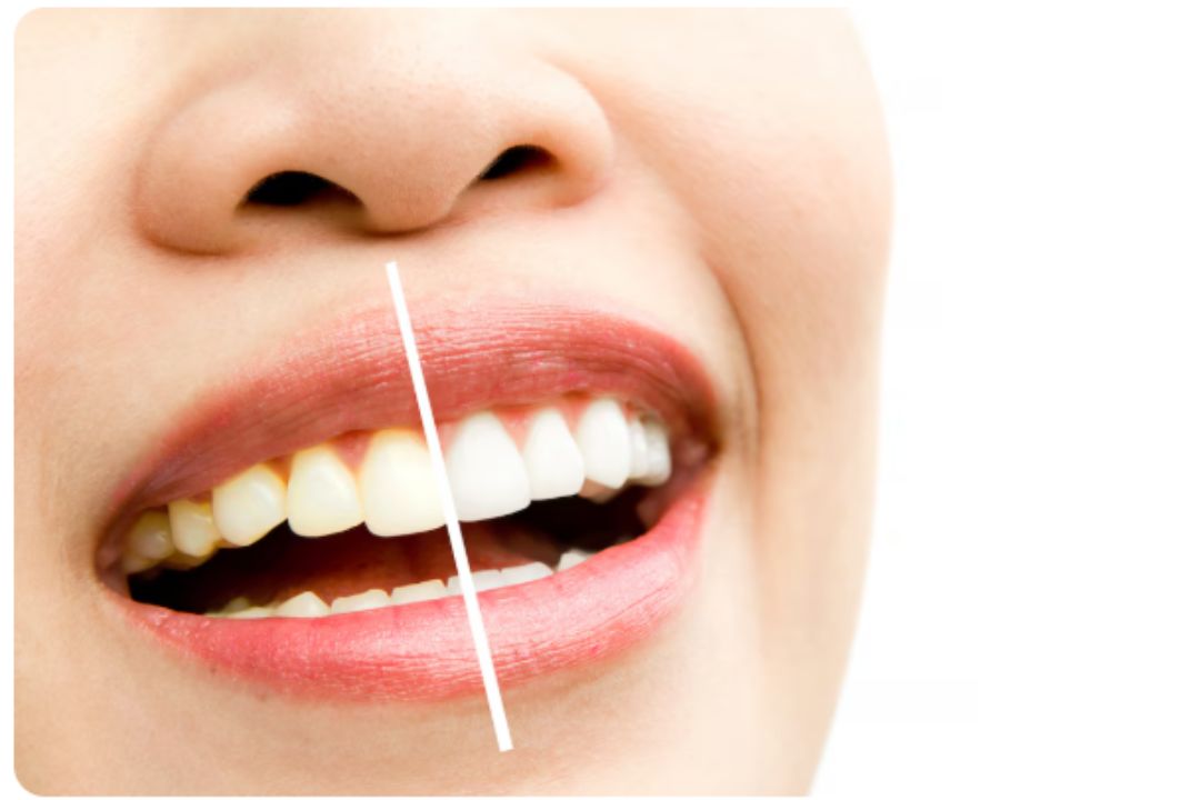 top yellow teeth treatment hospital in mumbai india 